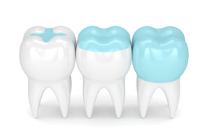 dallas childrens dental crowns