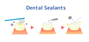 dallas kids dental sealants